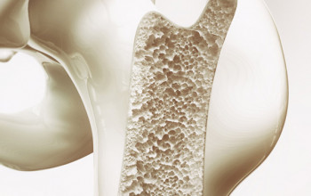 Bone Loss May Be Linked To a Higher Risk of Developing Dementia, Says Research 