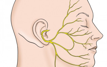 Image रामसे हंट सिंड्रोम क्या है? लक्षण, कारण और इलाज | Ramsay Hunt Syndrome in Hindi