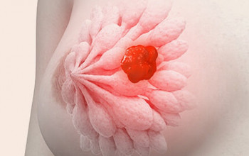 Image स्तन कैंसर क्या है? कारण, लक्षण, और उपचार | Breast Cancer in Hindi