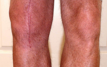 Image What are the complications after knee replacement?
