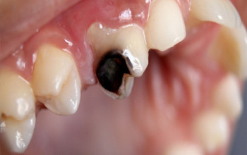 Image What everybody should know about dental caries?