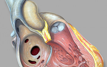 Image When do we intervene in ASD (Atrial septic defect)?