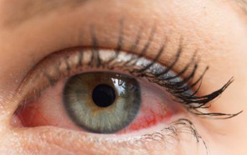 Image Dry eyes - Symptoms, Causes and Treatment | Medtalks