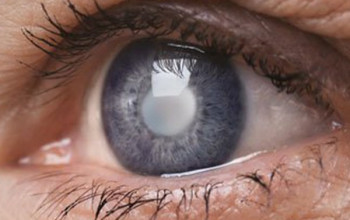 Image ग्लूकोमा यानि काला मोतिया कैसे गंभीर | Glaucoma in Hindi