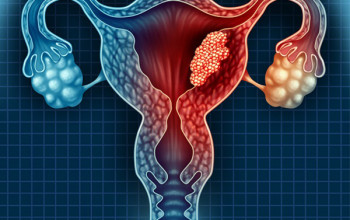 Image 5 year survival rate in cervical cancer