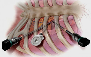 Image What is Minimal Invasive Heart Bypass Surgery treatment?