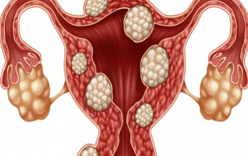 Image What is the treatment for fibroid?