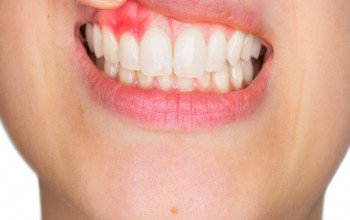 Image What everybody should know about gum disease?