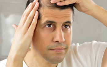 Image Hair Loss : Causes, Treatment & Prevention