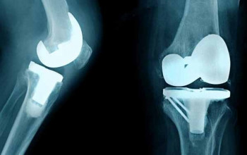Image Unilateral vs bilateral knee replacement?