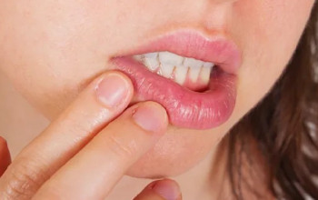 Image होंठ का कैंसर क्या है? कारण, लक्षण और इलाज| Lip Cancer in Hindi