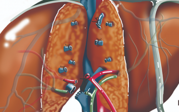 Image Liver Transplantation: Procedure, Eligibility, and Postoperative Care