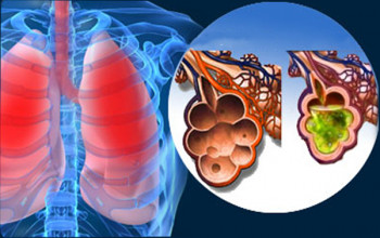 Image What is the management of acute respiratory distress syndrome (ARDS)?