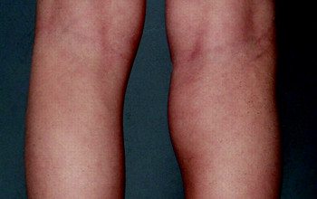 Image Oligoarthritis: Arthritis in Children