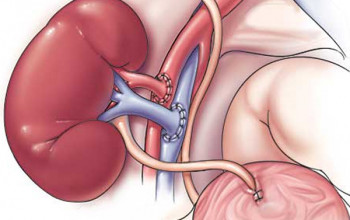 Image How should we manage CAD in a patient who is going for renal transplant?