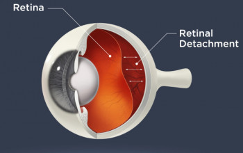 Image What is Retinal Detachment?