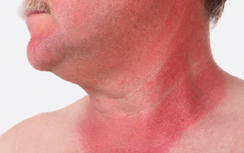 Image सनबर्न क्या है? कारण, लक्षण और इलाज | Sunburn in Hindi
