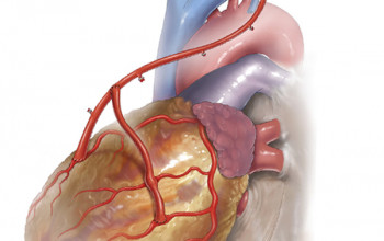 Image What is total arterial bypass surgery?