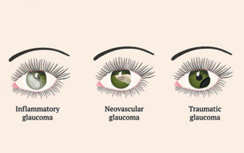 Image What are the type of glaucoma?