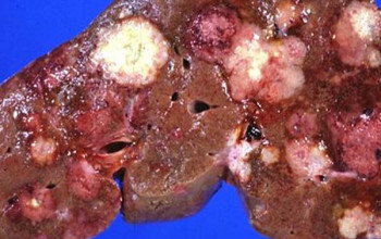 Liver Disorders in India: Understanding the Prevalence