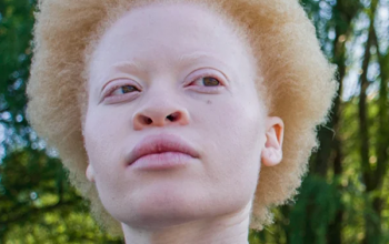 Image ऐल्बिनिज़म क्या है? कारण, लक्षण और इलाज | What is Albinism in Hindi