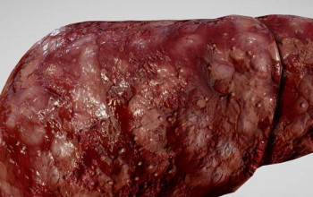 Image हेपैटोसेलुलर कार्सिनोमा (एचसीसी) क्या है? कारण, लक्षण और इलाज | What is Hepatocellular Carcinoma (HCC) in Hindi