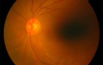 Image What is Retina?