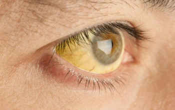 Image येलो फीवर क्या है | Yellow Fever in Hindi | Medtalks