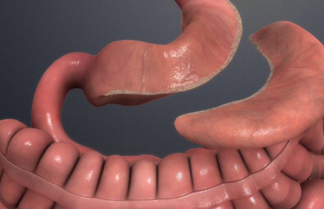 Image Impact of bariatric surgery on health-related quality of life in people with obesity