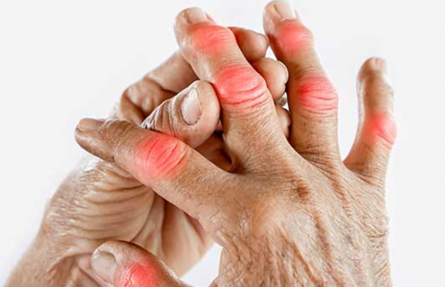 Image Arthritis: A Common Joint Disorder