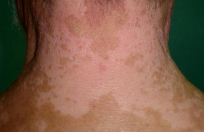 Image Can Vitiligo go for a remission?