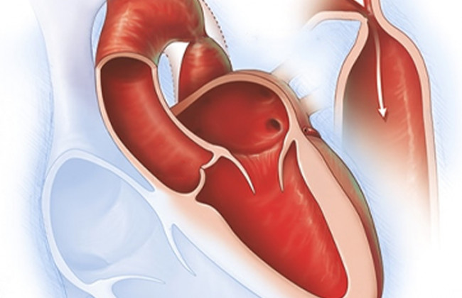 Image How should we diagnose coarctation of aorta?