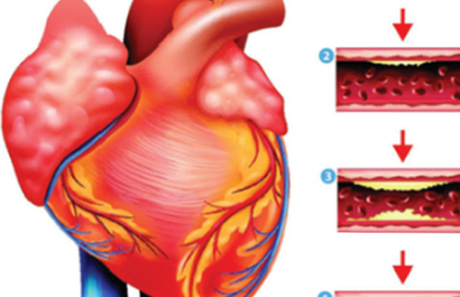 Image Differentiate progressive and non-progressive coronary artery disease?