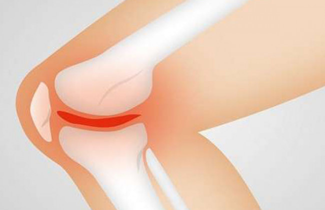 Image How common is osteoarthritis knee in india?