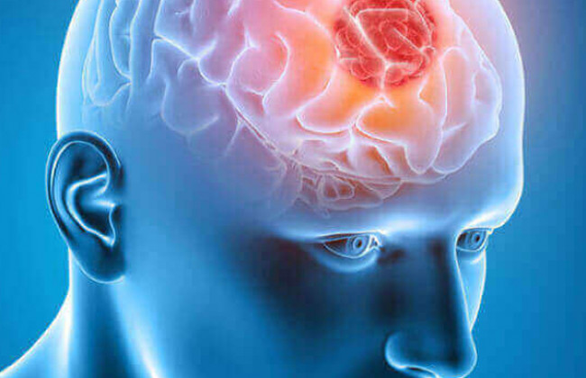 Image ऑलिगोडेंड्रोग्लियोमा क्या है? कारण, लक्षण और इलाज | Oligodendroglioma in Hindi