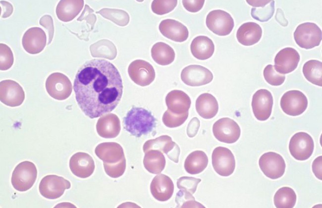 साइडरोबलास्टिक एनीमिया क्या है? कारण, लक्षण और इलाज | Sideroblastic Anemia in Hindi