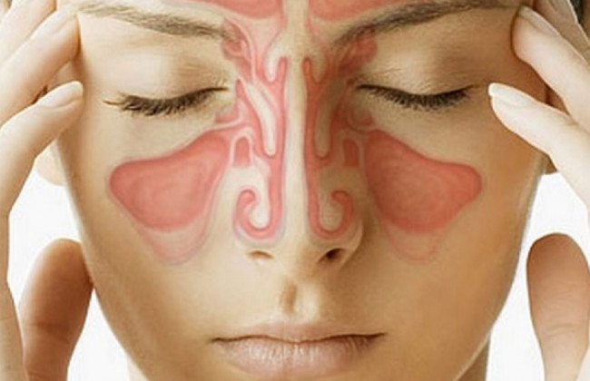 Image साइनोसाइटिस क्या है? कारण, लक्षण और इलाज | Sinusitis in Hindi