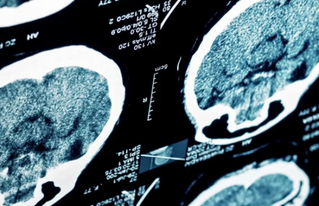 Image Sleep Behaviors and Subcortical Brain Structures in Children with Overweight/Obesity