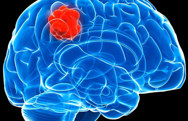 Image What treatment options are available for patients facing a brain tumor recurrence?