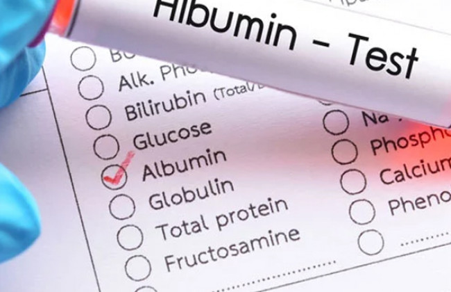 Image What you need to know about Albumin Test