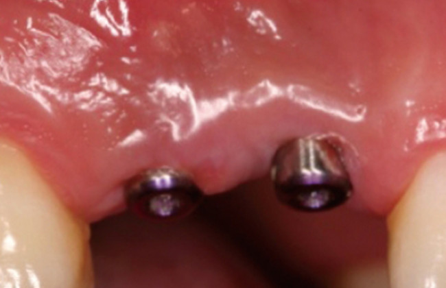 Image When do we a second stage surgery, for example after BT shunt when do we do a characteristic....?