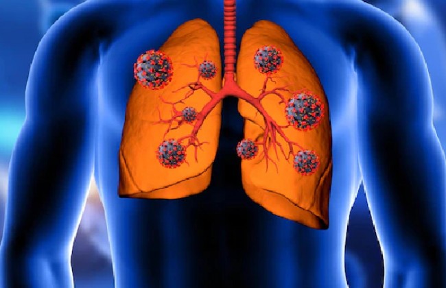 बैक्टीरियल निमोनिया क्या है? कारण, लक्षण और इलाज | Bacterial Pneumonia in Hindi