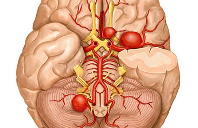 Image Brain Aneurysm - Symptoms and Causes | Medtalks