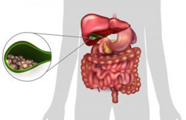 Image How should we manage biliary colic?