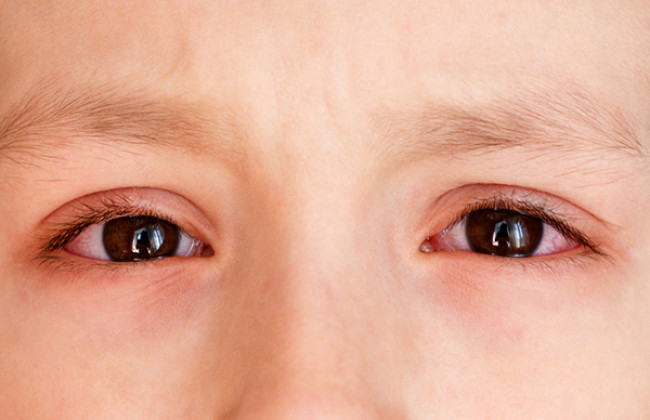 Image What are the common eye diseases in children?