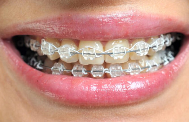 Image What everybody should know about dental braces?