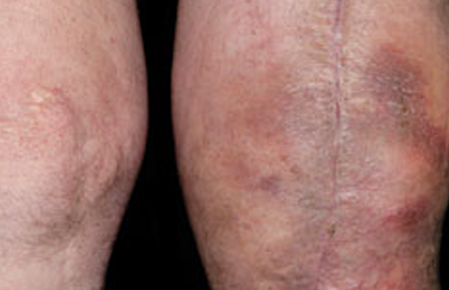 Image Knee Replacement Surgery: Is It Right for Older Adults with Knee Pain?