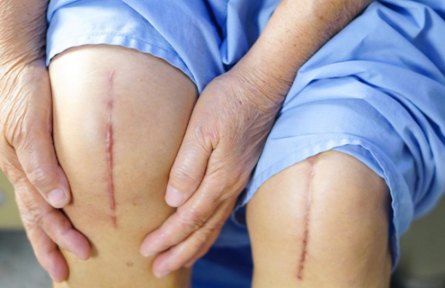 Image घुटने बदलने का ऑपरेशन या नी रिप्लेसमेंट सर्जरी के बारे में सब जाने | Knee Replacement in Hindi