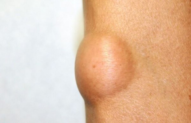 Image लिपोमा क्या है? कारण, लक्षण और इलाज | Lipoma in Hindi