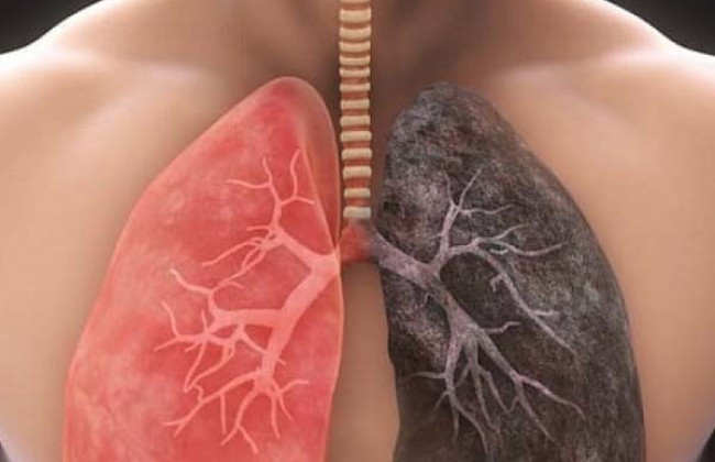Image इंटरस्टीशियल लंग डिजीज क्या है? कारण, लक्षण और इलाज | Interstitial Lung Disease in Hindi
